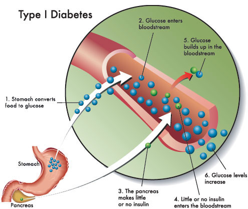 Type 1 diabetes