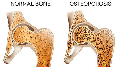 Osteoporosis