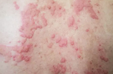 Severe skin rash